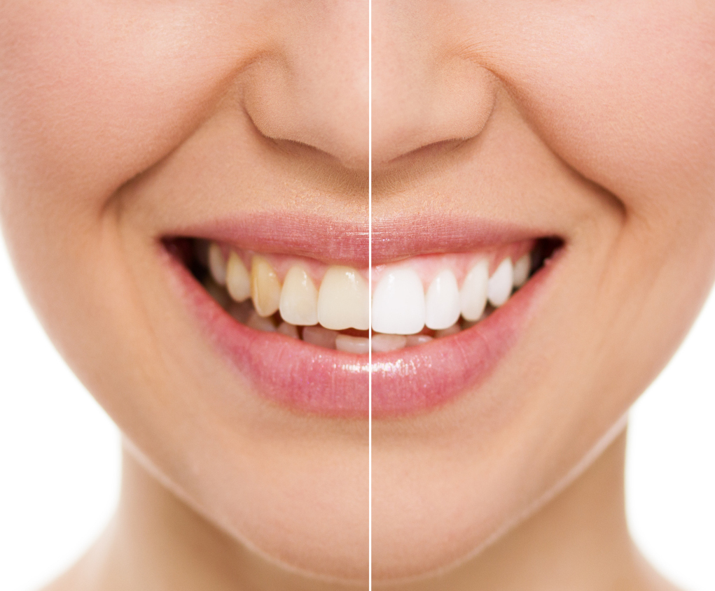 Как отбелить зубы: вред и польза домашнего отбеливания